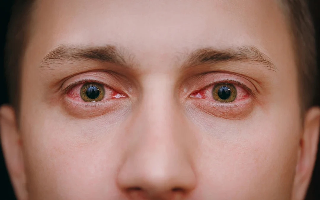 Spotting Pink Eye Early: What to Look for and How to Treat It