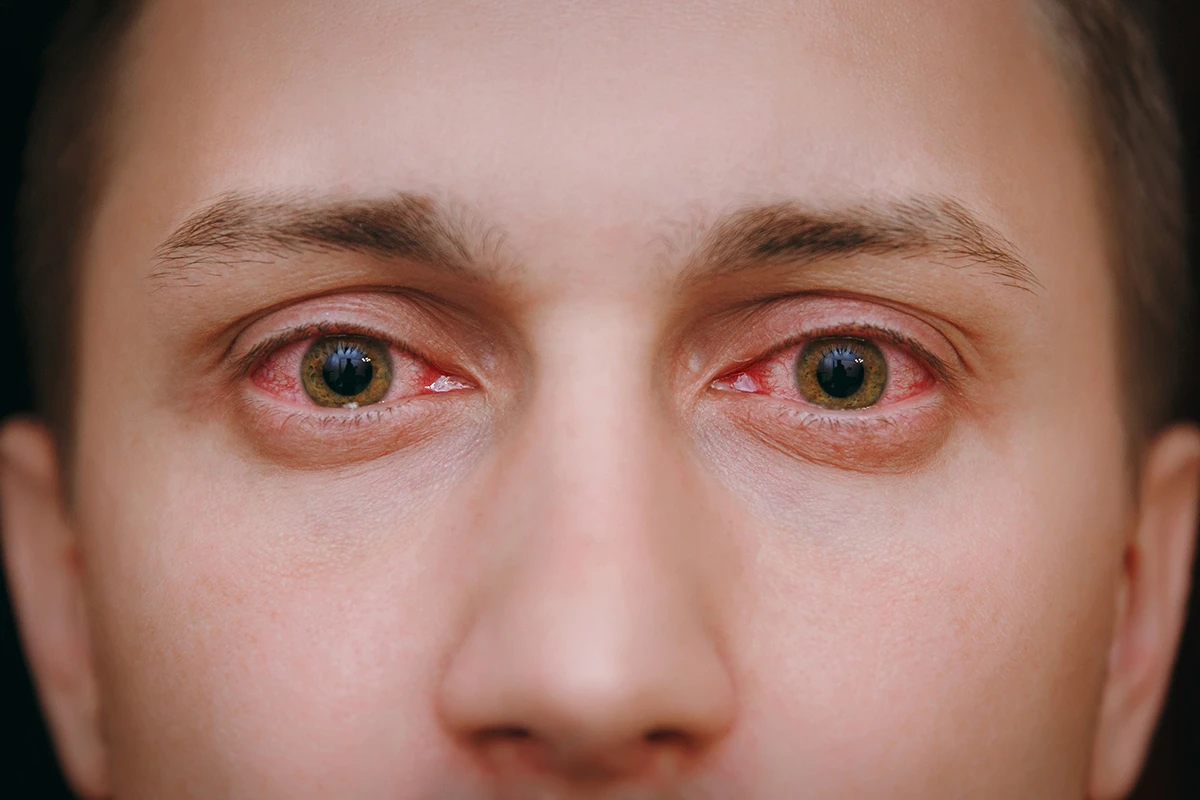 close-up of a man's eyes with pink eye